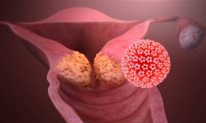 علائم HPV در زنان چیست؟